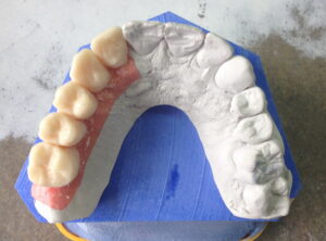 bridge_zircone_implants_1