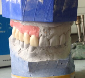 bridge_zircone_implants_2