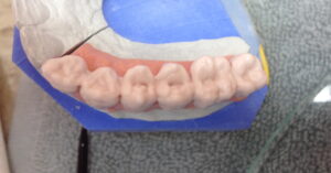 bridge_zircone_implants_3