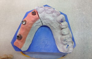 bridge_zircone_implants_4