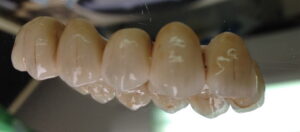 bridge_zircone_implants_5