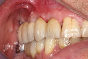 bridge_zircone_implants_6