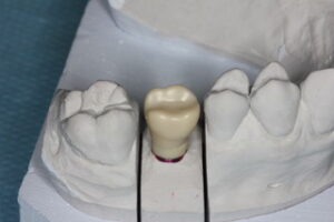 pilier_zircone_1