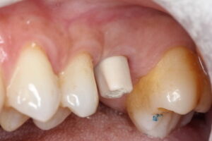 pilier_zircone_3