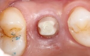 pilier_zircone_4