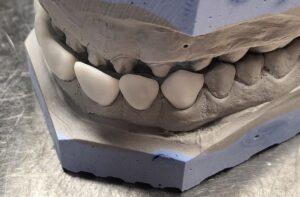 wax_up_1