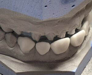 wax_up_2