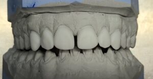 wax_up_3