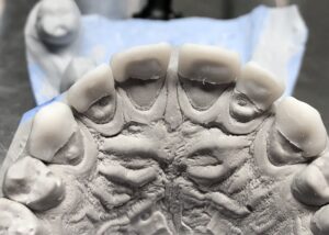 wax_up_4