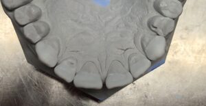 wax_up_5