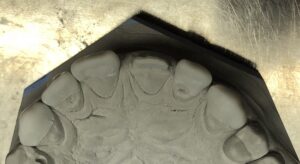 wax_up_6
